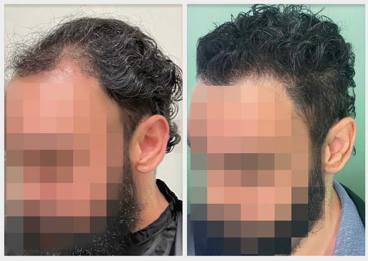 Antes-e-depois-7-meses-Louvi-Clinic