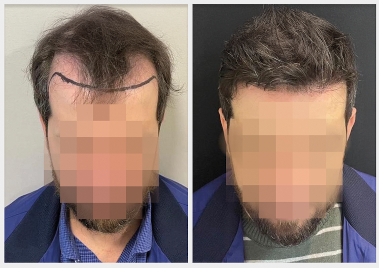 Antes-e-depois-8-meses-Louvi-Clinic
