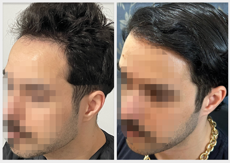 antes-e-depois-louvic 4