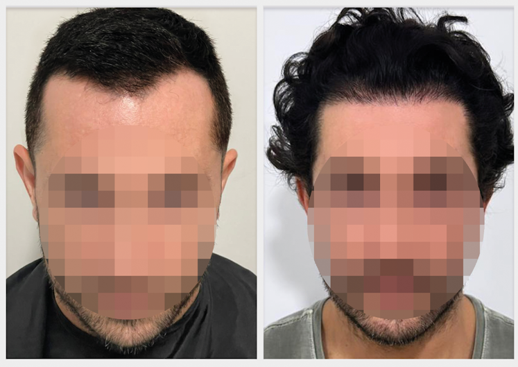 antes-e-depois-louvic