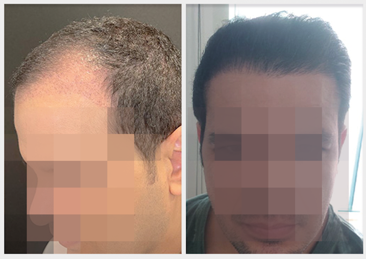 modelo_antes depois 5