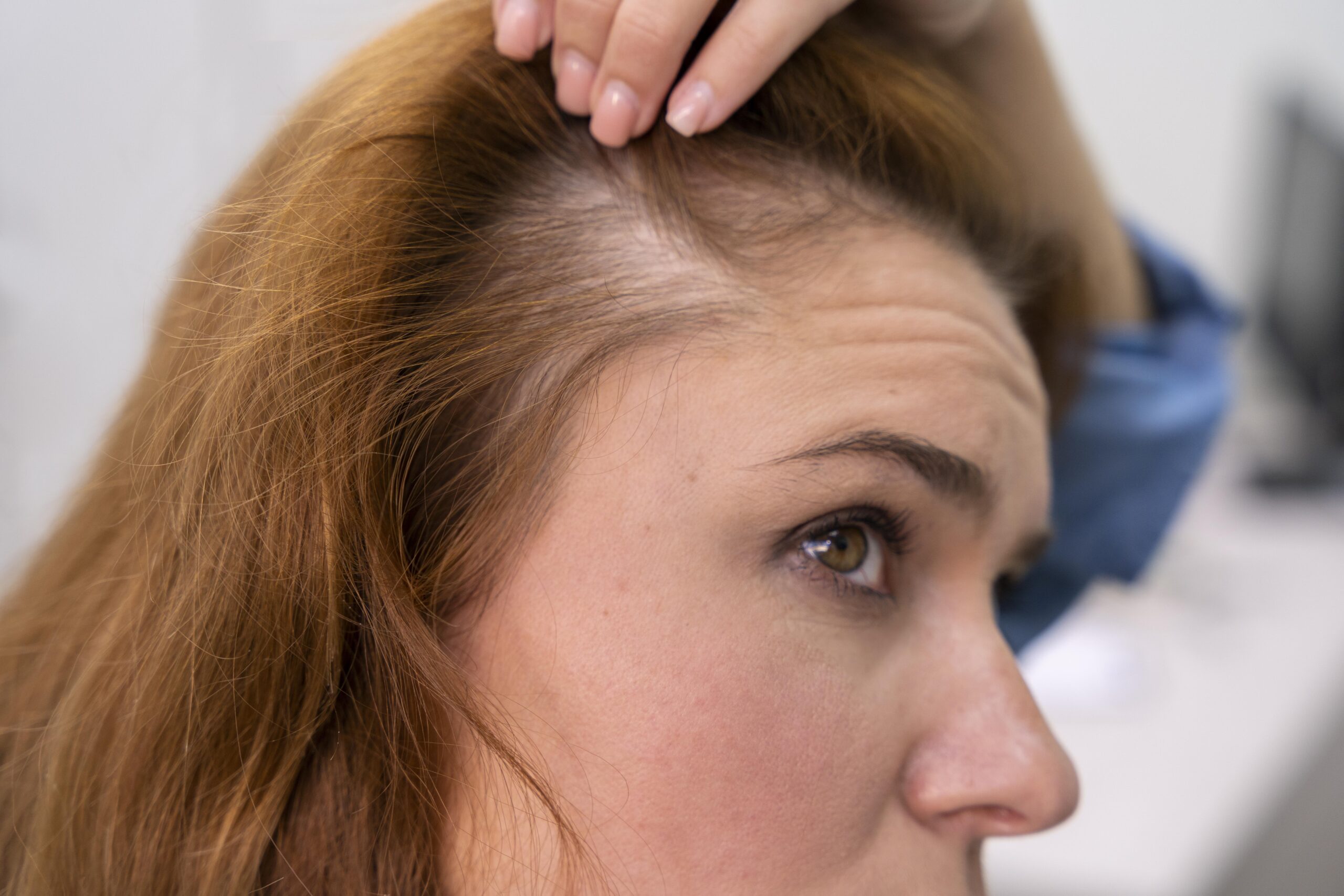 Implante de Cabelo Feminino Como Recuperar a Densidade e a Autoestima