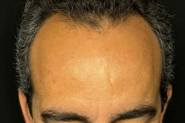 antes