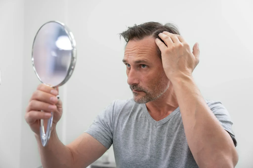 Queda de Cabelo em Homens: Quais as Principais Causas e Como Identificar os Primeiros Sinais A queda de cabelo em homens é um dos temas mais procurados nos consultórios dermatológicos e uma das maiores preocupações estéticas masculinas. Segundo dados da Sociedade Brasileira de Dermatologia, cerca de 42% dos homens acima dos 30 anos apresentam algum grau de calvície, e esse número sobe para mais de 60% após os 50 anos. Apesar de tão comum, muitos ignoram os primeiros sinais e só buscam ajuda quando a perda já está avançada — o que torna o tratamento mais difícil. Entender as causas, identificar os sintomas iniciais e agir precocemente faz toda a diferença nos resultados do tratamento. A boa notícia é que hoje há recursos tecnológicos e terapias eficazes que podem controlar a queda e estimular o crescimento dos fios. Entendendo a queda de cabelo masculina O ciclo natural dos fios O cabelo passa por três fases naturais: crescimento (anágena), transição (catágena) e queda (telógena). Em condições normais, perder até 100 fios por dia é algo esperado. O problema começa quando essa perda se torna progressiva e perceptível, com falhas visíveis no couro cabeludo. Quando a queda deixa de ser normal Nem toda queda indica calvície, mas é fundamental observar mudanças no padrão. Quando há afinamento dos fios, rarefação no topo da cabeça ou entradas mais evidentes, pode haver um processo de alopecia em andamento. Detectar cedo é essencial para evitar danos irreversíveis aos folículos. O impacto emocional e social Além do aspecto estético, a queda capilar pode afetar autoestima e confiança. Estudos mostram que homens que sofrem com calvície têm maior propensão a quadros de ansiedade e retraimento social. A boa notícia é que, hoje, a dermatologia e a tricologia oferecem soluções cada vez mais eficazes. Principais causas da queda de cabelo em homens Alopecia androgenética: o fator genético e hormonal Responsável por cerca de 80% dos casos de calvície masculina, a alopecia androgenética tem origem genética e está ligada à ação do hormônio DHT (dihidrotestosterona), que enfraquece os folículos ao longo do tempo. O padrão mais comum é o recuo nas entradas e o afinamento no topo da cabeça. Estresse e desequilíbrios hormonais O estresse físico ou emocional pode desencadear o eflúvio telógeno, uma queda difusa e temporária que ocorre meses após o gatilho inicial. Alterações hormonais, como hipotireoidismo ou níveis irregulares de testosterona, também estão entre as causas recorrentes. Deficiências nutricionais e dietas restritivas Falta de ferro, zinco, biotina, vitamina D e proteínas prejudica a saúde capilar. Dietas extremas e emagrecimentos rápidos podem causar queda acentuada, pois o organismo prioriza funções vitais, deixando o cabelo em segundo plano. Uso de medicamentos e anabolizantes Certos medicamentos, como anticoagulantes e antidepressivos, podem alterar o ciclo capilar. Já o uso de anabolizantes é um fator de risco importante, pois eleva o DHT e acelera o processo de miniaturização dos fios. Doenças autoimunes e inflamatórias Condições como alopecia areata, lúpus e dermatite seborreica também provocam queda significativa. Nestes casos, o acompanhamento dermatológico é indispensável para diagnóstico e controle adequado. Como identificar os primeiros sinais de calvície Afinamento e rarefação capilar O primeiro sinal costuma ser o afinamento progressivo dos fios, especialmente nas regiões frontal e superior. Essa mudança na densidade capilar pode ser discreta, mas é perceptível com o tempo. Recuo da linha frontal e entradas acentuadas Entradas mais visíveis e linha de implantação do cabelo recuada indicam início de calvície androgenética. Fotografar o couro cabeludo em intervalos regulares ajuda a comparar e perceber a evolução. Mais fios no travesseiro e no chuveiro Ver muitos fios caindo no ralo, no travesseiro ou nas mãos durante o banho é um alerta. Embora a queda diária seja normal, o aumento repentino exige atenção. Alterações no couro cabeludo Coceira, oleosidade excessiva e descamação também merecem cuidado, pois podem sinalizar inflamações que agravam a perda capilar. 🔍 Checklist rápido: primeiros sinais de queda de cabelo Fios mais finos e frágeis ao toque; Entradas ou topo da cabeça com menor densidade; Mais fios no travesseiro, chuveiro ou pente; Oleosidade e coceira frequentes no couro cabeludo; Linha frontal do cabelo recuando visivelmente. Se você identificou dois ou mais desses sinais, é hora de procurar um dermatologista especializado. Fatores de risco e hábitos que agravam a queda Histórico familiar e predisposição genética Homens com pai, avô ou tios calvos têm maior probabilidade de desenvolver alopecia. Esse fator hereditário influencia diretamente a sensibilidade dos folículos ao DHT. Estilo de vida e rotina Noites mal dormidas, tabagismo, má alimentação e excesso de álcool afetam a circulação sanguínea e o equilíbrio hormonal, impactando o crescimento dos fios. Cuidados inadequados com o cabelo O uso excessivo de produtos químicos, secadores muito quentes ou penteados que tracionam o cabelo (como topetes e coques) pode acelerar a queda e causar quebra mecânica. Quando procurar um dermatologista Identificação precoce é a chave Quanto mais cedo o diagnóstico é feito, maiores as chances de preservar os fios. O dermatologista avalia o histórico clínico, hábitos e fatores genéticos, e pode solicitar exames como tricoscopia e dosagens hormonais. Tratamentos personalizados Hoje, há uma variedade de opções eficazes, como loções com minoxidil, medicamentos antiandrogênicos, suplementação nutricional, microagulhamento e laser capilar de baixa intensidade. O ideal é uma abordagem personalizada, definida após avaliação profissional. Resultados reais e acompanhamento contínuo Tratar queda de cabelo exige paciência e constância. Resultados visíveis costumam aparecer entre 3 e 6 meses, dependendo do caso. O acompanhamento regular garante ajustes e manutenção do progresso. Medidas preventivas e cuidados iniciais Hábitos saudáveis Uma rotina equilibrada, com sono adequado, boa alimentação e controle do estresse, é fundamental para manter o cabelo forte. Exercícios físicos também melhoram a circulação do couro cabeludo. Cuidados diários com o couro cabeludo Evite produtos com álcool e lave o cabelo regularmente com shampoos neutros ou específicos para o seu tipo de couro cabeludo. A higienização correta reduz a oleosidade e previne inflamações. Evite a automedicação Evitar a automedicação é essencial quando se trata de queda de cabelo. Muitos produtos vendidos sem prescrição, como loções e suplementos, prometem resultados rápidos, mas podem agravar o problema ou mascarar doenças subjacentes. O uso incorreto de fórmulas manipuladas, hormônios ou vitaminas em excesso pode causar irritação, alergias e até acelerar a queda. Por isso, o acompanhamento com um dermatologista é indispensável. Somente o especialista pode avaliar o tipo de alopecia, identificar suas causas e indicar o tratamento ideal, seguro e eficaz para o seu caso específico. Conclusão: cuidar cedo é investir em si mesmo A queda de cabelo em homens é um processo multifatorial, mas tratável — especialmente quando identificada no início. Observar os primeiros sinais e buscar orientação profissional é o passo mais importante para preservar a aparência e o bem-estar. Se você começou a notar falhas, fios mais finos ou rarefação, procure a Louvi Clinic. A equipe especializada em dermatologia e tricologia oferece diagnóstico completo, tecnologias de ponta e acompanhamento individualizado para restaurar a saúde e a confiança dos seus cabelos. 👉 Agende uma avaliação e descubra como a Louvi pode ajudar você a controlar a queda e recuperar seus fios com segurança e resultados reais. Referências externas: Sociedade Brasileira de Dermatologia National Center for Biotechnology Information (NCBI) – Hair Loss Overview Leituras recomendadas no blog Louvi Clinic: Cuidados com o couro cabeludo: o que evitar no dia a dia Como a nutrição influencia na saúde da pele e do cabelo